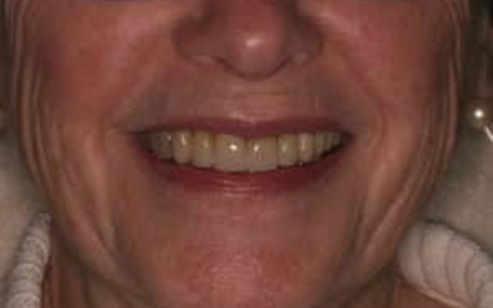Dentist in Renton Benson Hill Smiles